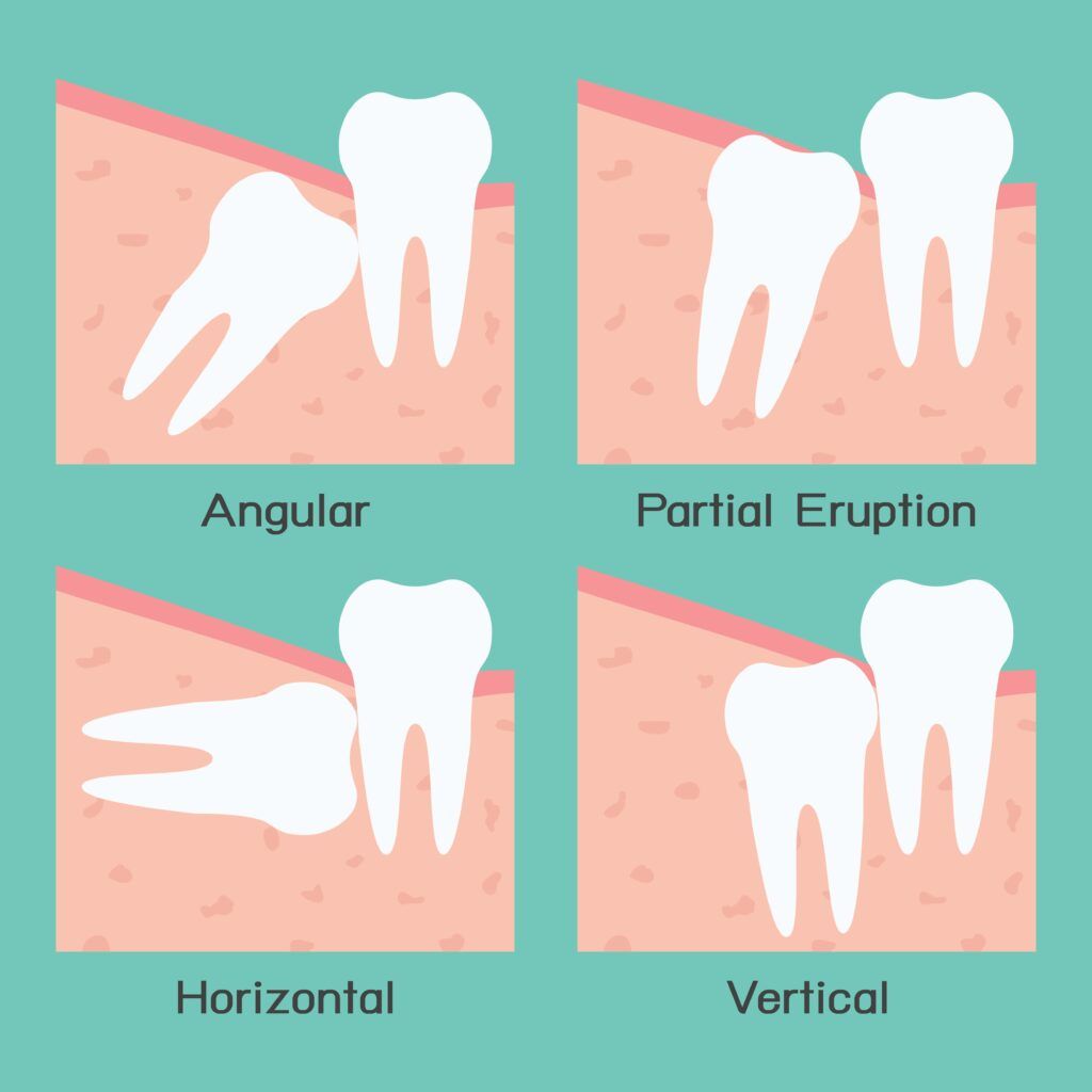 types of wisdom teeth impaction