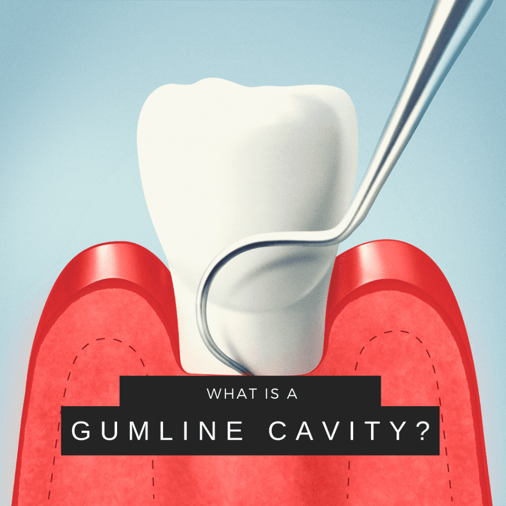 What is a gumline cavity (2)