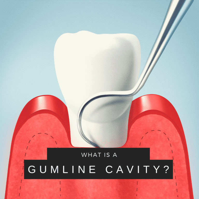 What is a gumline cavity (2)