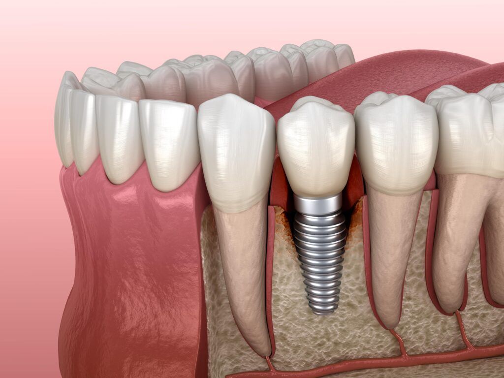 infected dental implant