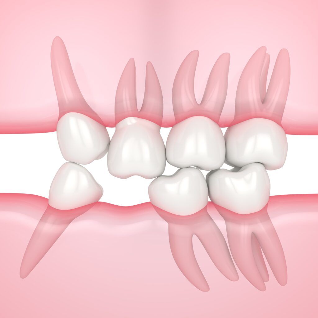 problems caused by missing tooth