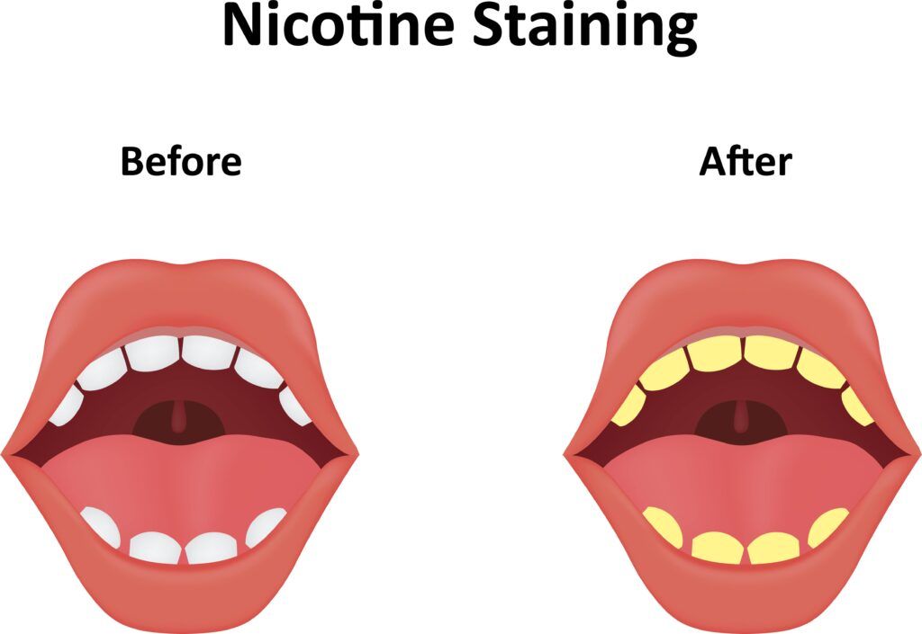 teeth before and after nicotine stains