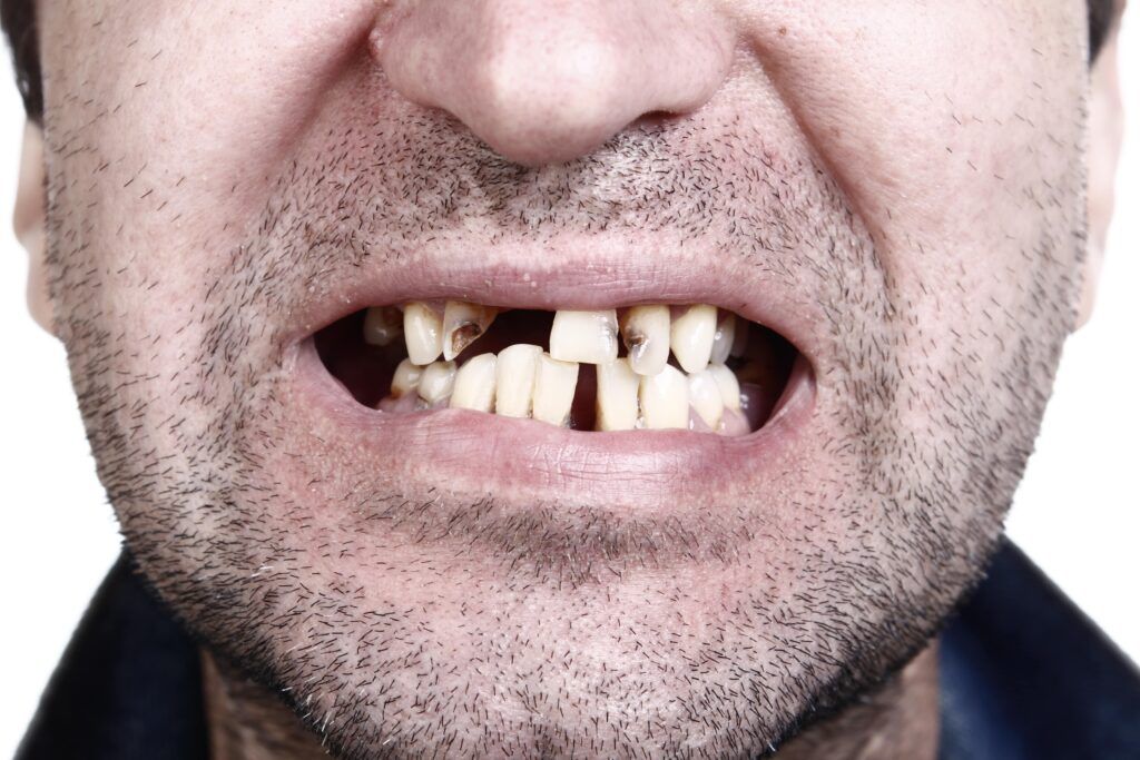 man with horrible teeth