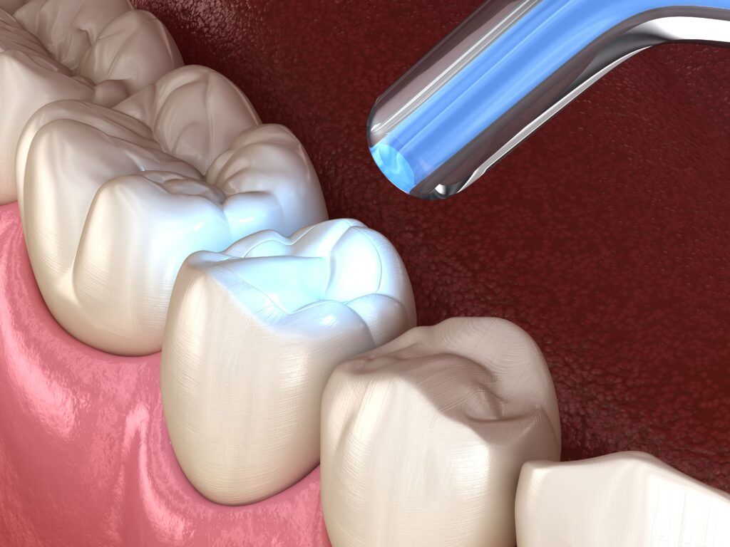 composite filling being hardened on tooth