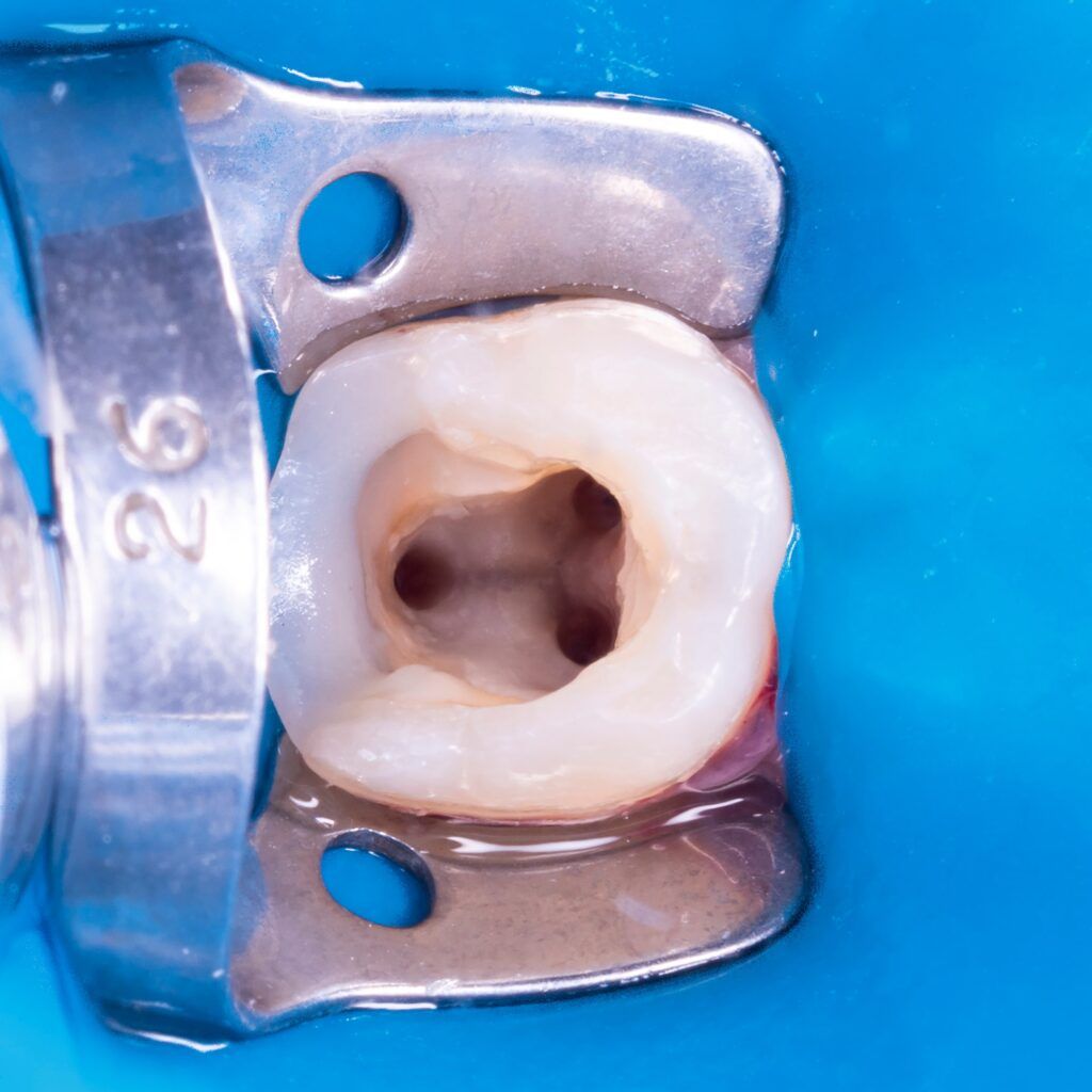 hollow tooth after root canal