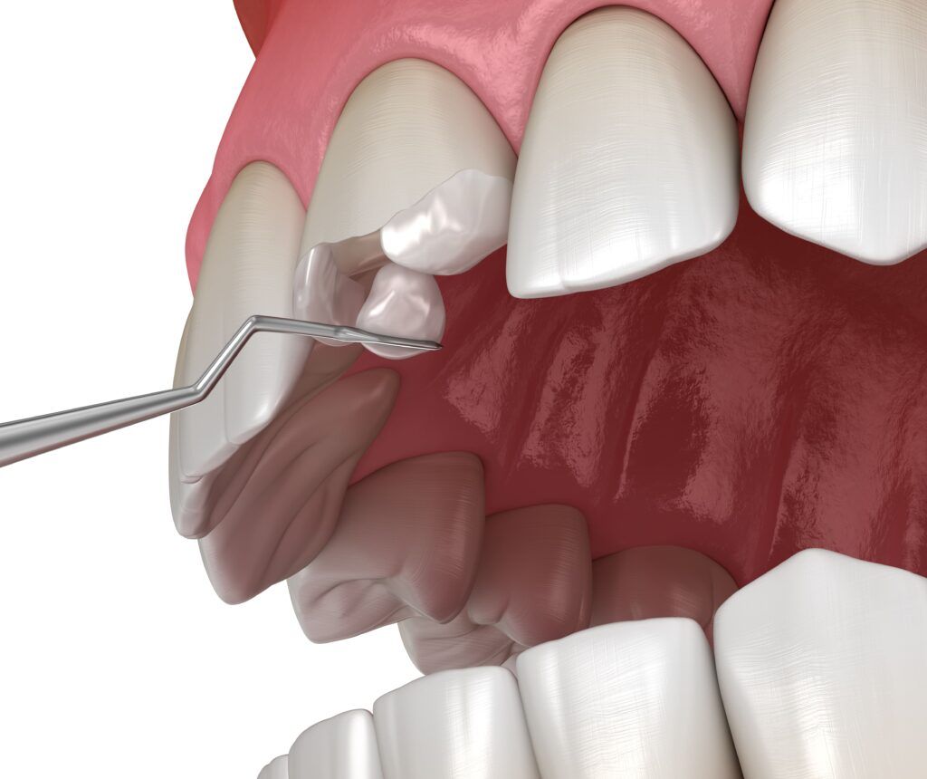 fixing chipped tooth with dental bonding