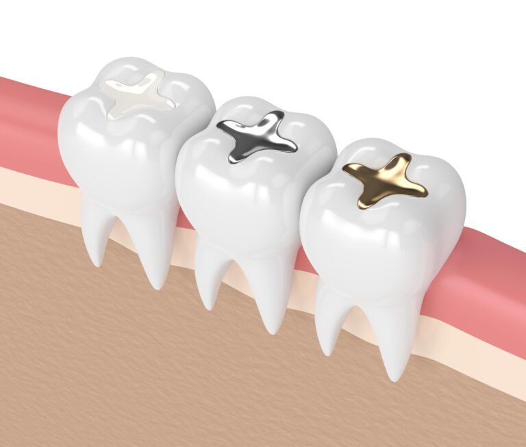 different types of fillings: composite, silver, gold
