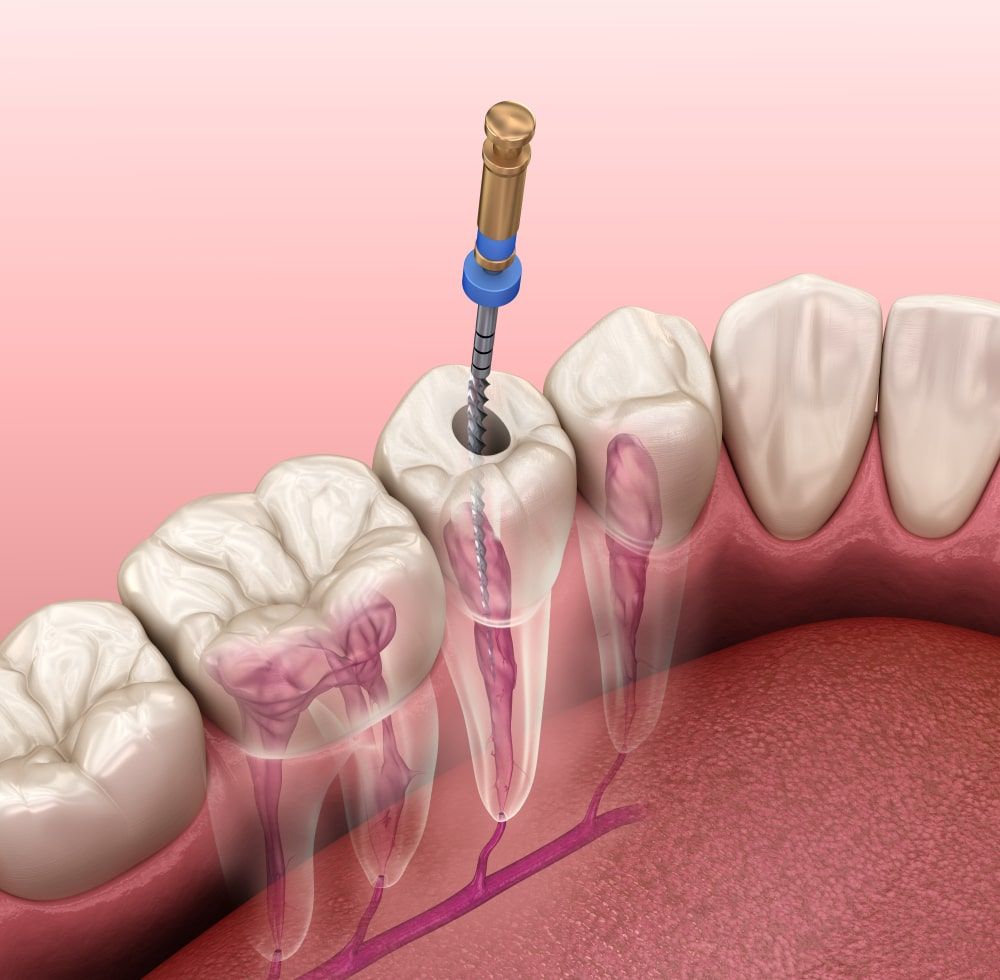 root canal being performed on tooth