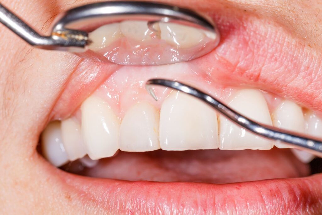 dental tools being used in mouth