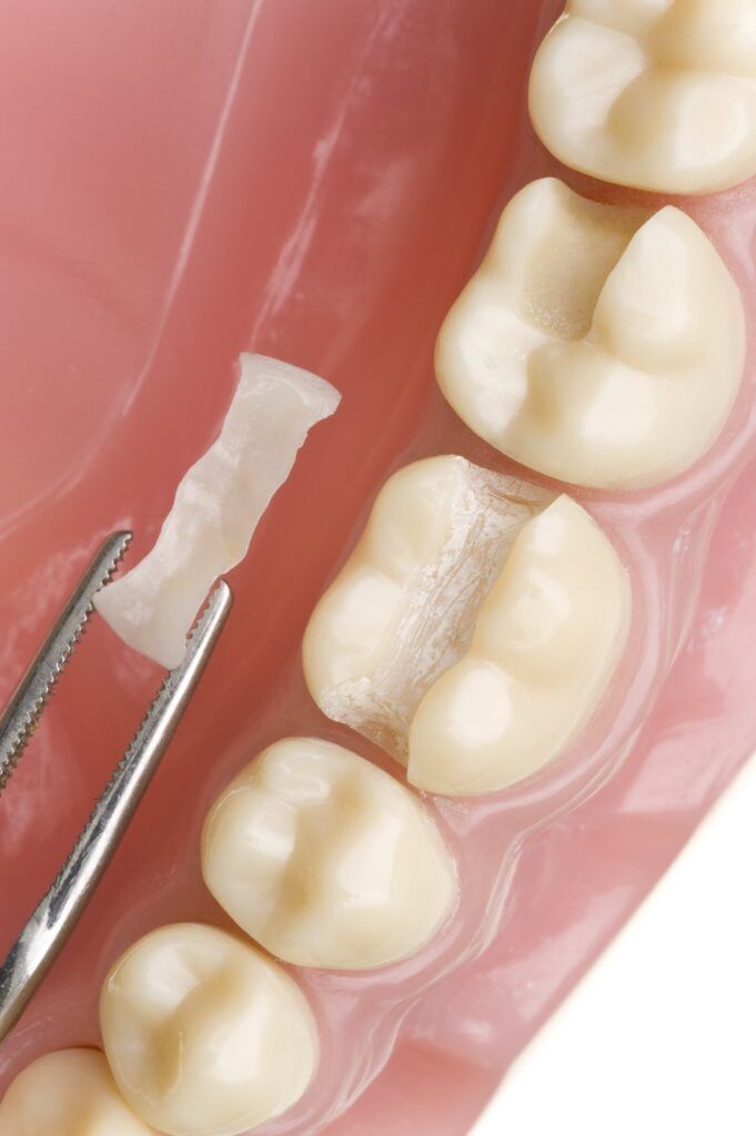 dental inlay being placed on tooth