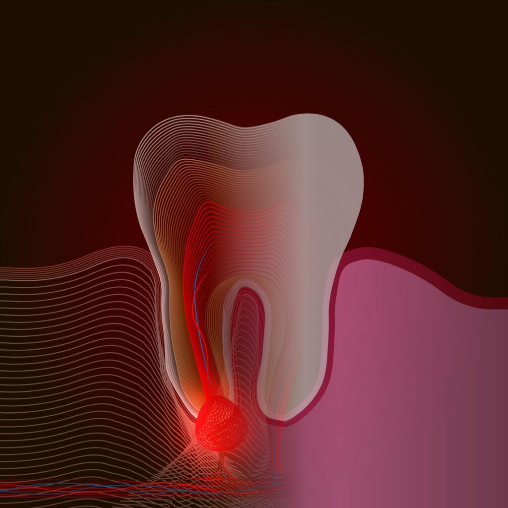 infected tooth and sore tooth nerve (pulpitis)