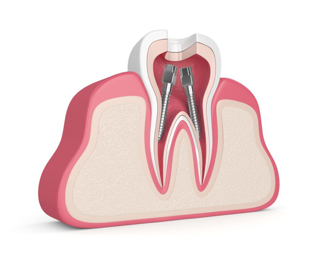 3d render of tooth in gums with dental root canal posts