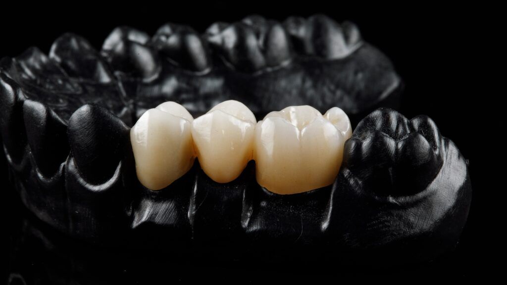 white dental bridge on black tooth model