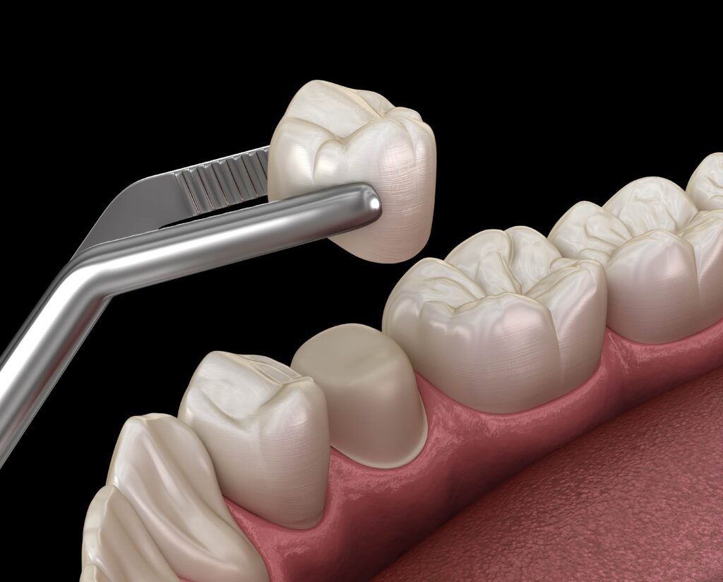 dental crown being placed over tooth