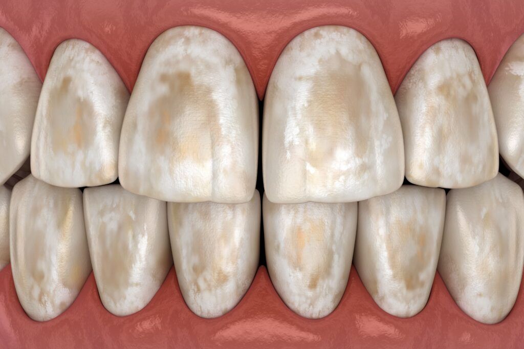 teeth with erosion