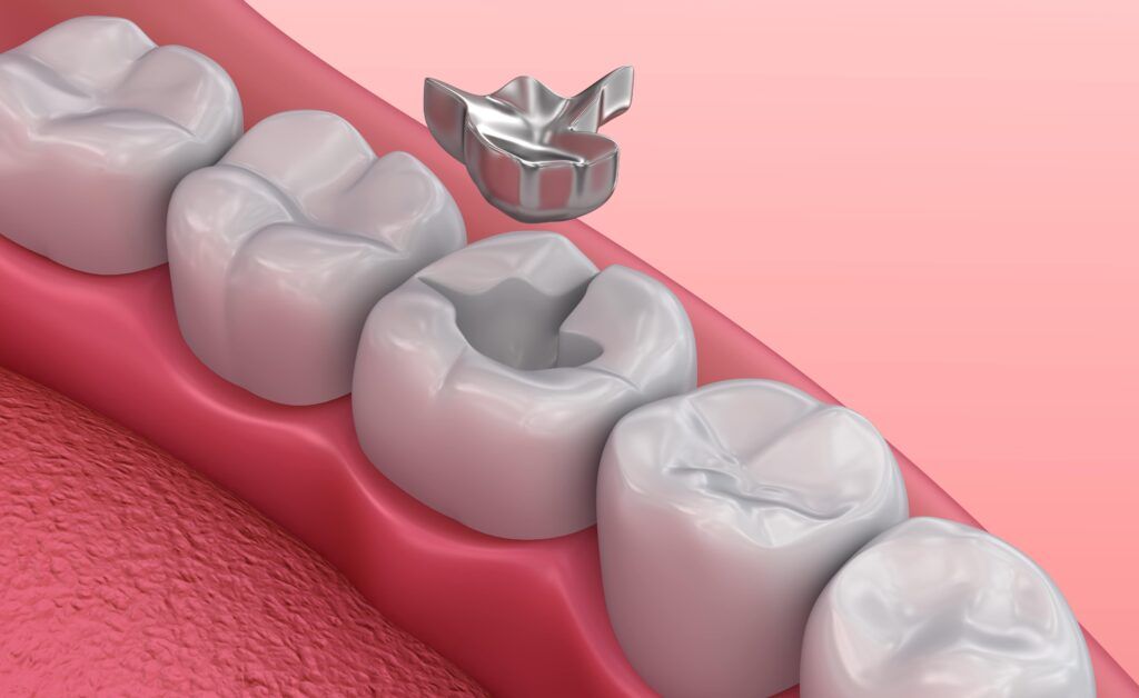 dental illustration of a metal filling being placed in molar