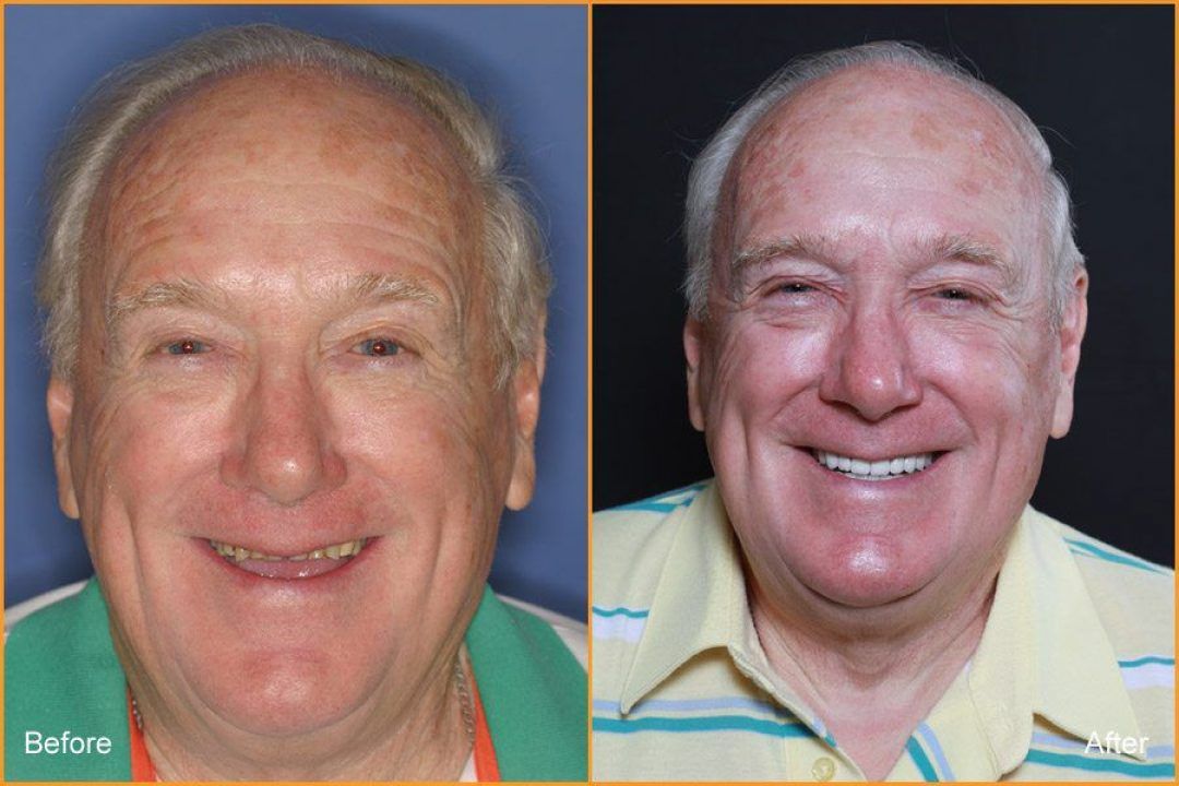 Full Face of Man Before and After Dental Treatment