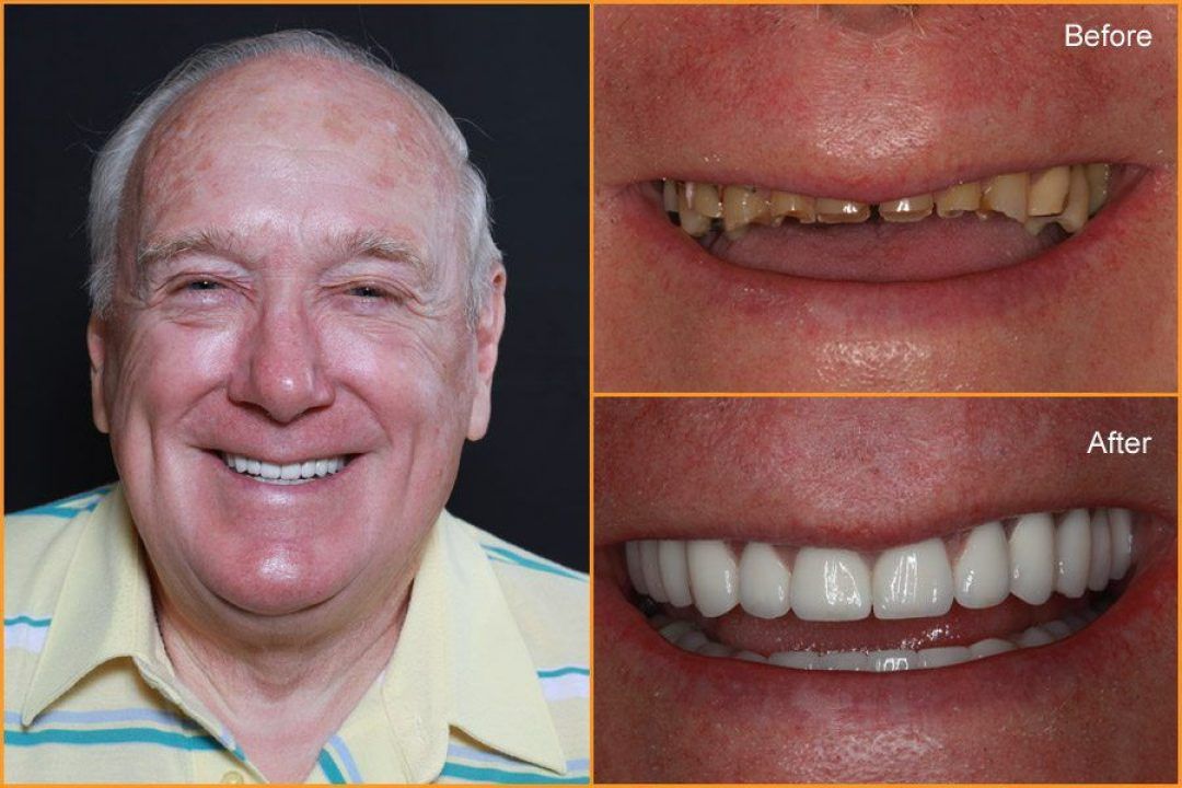 Close up of Man's teeth Before and After Dental Treatment