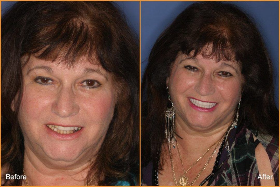 Full Face of woman Before and After Dental Treatment