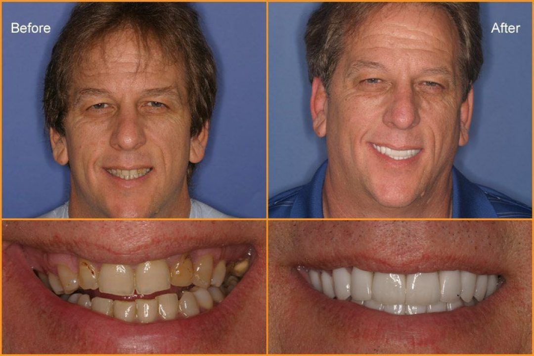 Man's full face and close up of teeth Before and After Dental Treatment