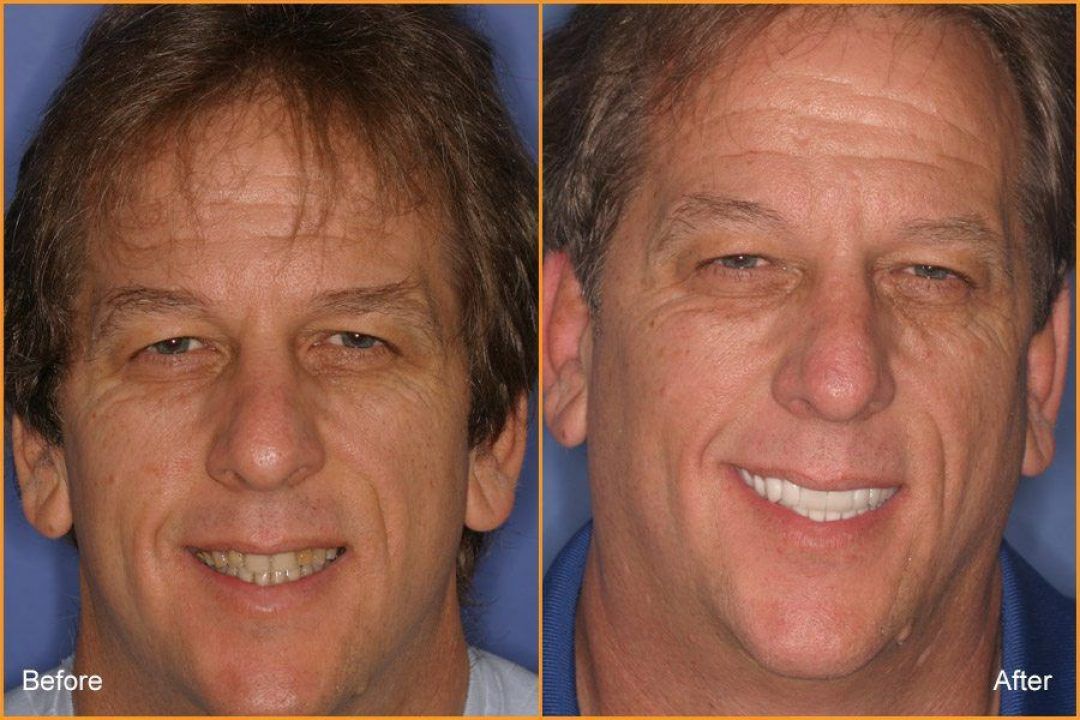 Full Face of Man Before and After Dental Treatment