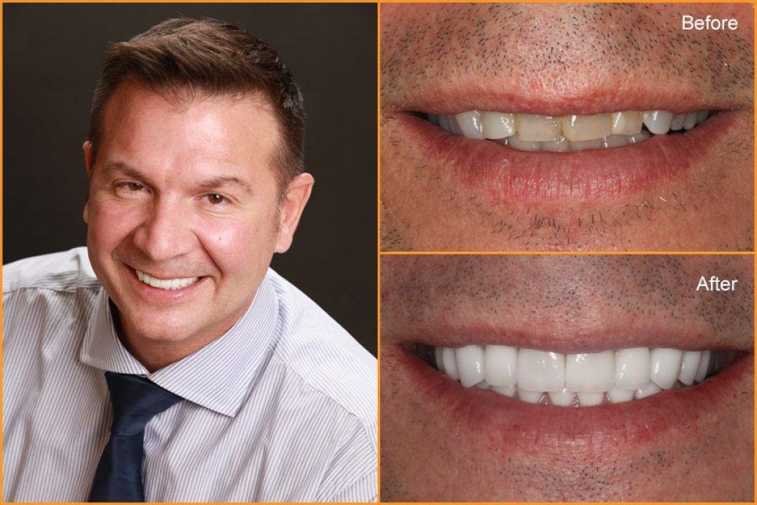 Close up of Man's teeth Before and After Dental Treatment
