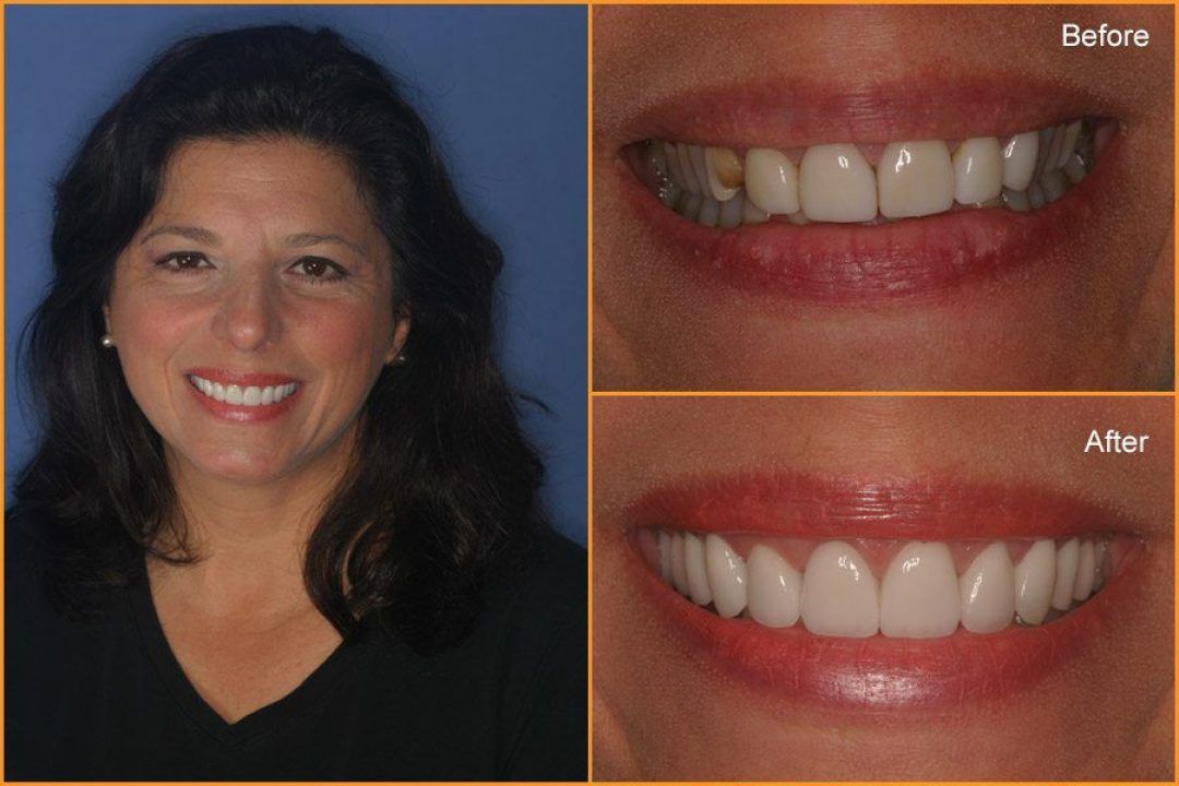 Close up of Woman's teeth Before and After Dental Treatment