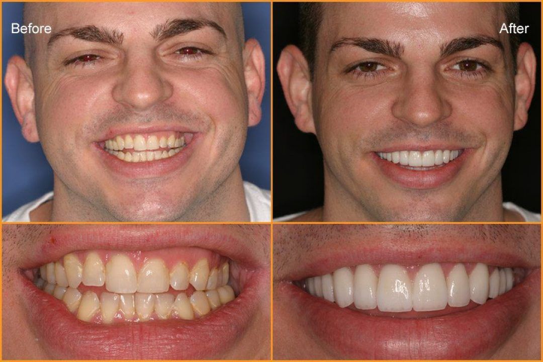 Man's full face and close up of teeth Before and After Dental Treatment
