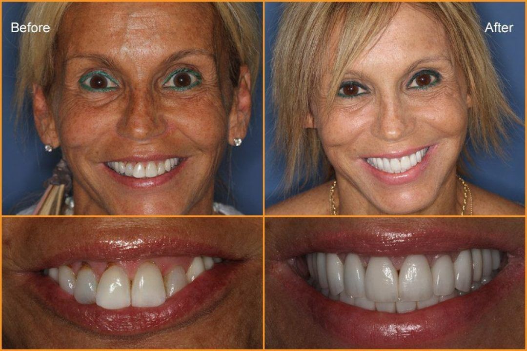 Woman's full face and close up of teeth Before and After Dental Treatment