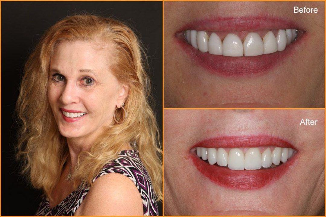 Close up of Woman's teeth Before and After Dental Treatment
