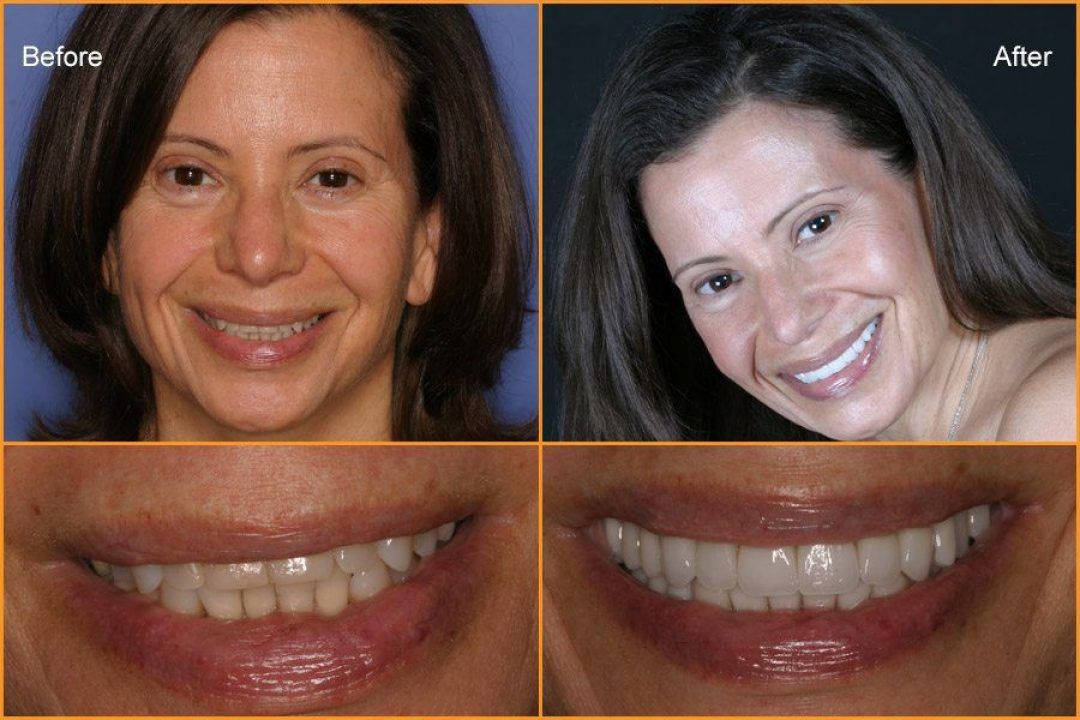 Woman's full face and close up of teeth Before and After Dental Treatment