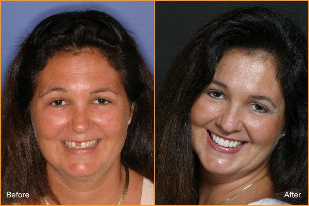Full Face of woman Before and After Dental Treatment
